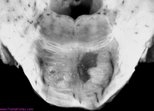 Recent and cavitated lacunar infarcts